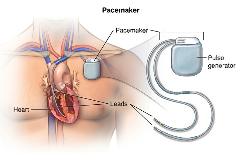 心臟調節器包含兩大部分：起搏器（pulse generator）和電極導線（lead）。（source：hopkinsmedicine.org）